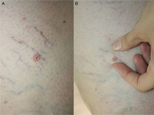 A, Erythematous papule overlying varices on the right thigh of a woman with chronic venous insufficiency. B, The subcutaneous component of the lesion can be observed.