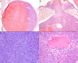Histopathology: A, A solid-cystic lesion in the dermis. Hematoxylin and eosin (H&E), original magnification×20). B, Image showing the focal connection with the overlying epidermis. H&E, original magnification×20). C, Poroid cells with scant cytoplasm, round or oval nuclei, and small nucleoli. H&E, original magnification×400. D, Cuticular cells with abundant eosinophilic cytoplasm lining a duct lumen. H&E, original magnification×400.