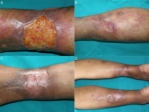A and B, Skin ulcers with necrotic slough on a background of livedo racemosa and retiform purpura secondary to calciphylaxis. C and D, Healing of the calciphylaxis-induced ulcers after treatment with intralesional sodium thiosulfate.