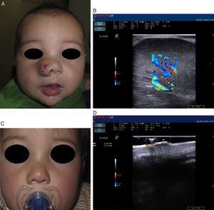 Infantile hemangioma on the right nostril treated with propanolol (courtesy of Dr. E. Baselga). A, Lesion prior to treatment. B, Echo Doppler image of hemangioma in proliferative phase; note the abundant vascularization. C, Clinical improvement of the nasal hemangioma. D, Decreased vascularization and thickness of the lesion.