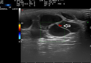 Lymphatic malformation. Color Doppler ultrasound Hyperechoic cystic areas can be seen with no blood flow within the lesion. The vessels are located in the walls of the malformation (arrow).