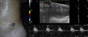 A, Reddish-violaceous nodule on the right ankle. B, The ultrasound lesion shows a solid, hypoechoic, homogeneous oval lesion with regular, well-defined edges in the papillary and reticular dermis. Color Doppler shows intense intralesional vascularization that is more marked in the inferior pole. Biphasic arterial flow is observed in spectral mode.