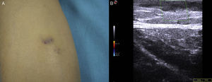A, Reddish-violaceous plaque on the anterior surface of the left thigh. B, The ultrasound examination revealed a solid, hypoechoic, heterogeneous lesion with irregular, acicular edges in the papillary dermis. Color Doppler did not reveal intralesional vascularization.