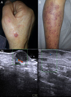 A, Reddish-violaceous nodule on the dorsum of the right hand. B, Multiple reddish-violaceous papules coalescing to form plaques on the anterior surface of the legs. C, Ultrasound of the nodule revealed a solid, hypoechoic, homogeneous oval lesion with well-defined and regular edges in the papillary and reticular dermis. Color Doppler revealed mild intralesional vascularization in the inferior pole. D, Ultrasound examination of the plaque revealed a solid, hypoechoic, heterogeneous lesion with irregular, acicular edges in the papillary dermis. No intralesional vascularization was observed in color Doppler.
