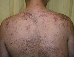 Papulopustular eruption in a patient in treatment with everolimus for subependymal giant cell astrocytoma associated with tuberous sclerosis. Clinically, this eruption resembles the eruption that develops with epidermal growth factor inhibitors. It is characterized by the appearance, 2 to 4 weeks after starting treatment, of monomorphic papules and follicular center pustules, with variable pruritus, without comedones or cysts, with a predilection for the trunk.
