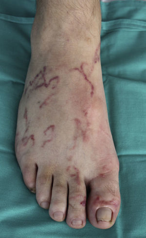 Multiple serpiginous tracts on the dorsum foot.