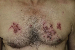 Multiple serpiginous tracts on the trunk.