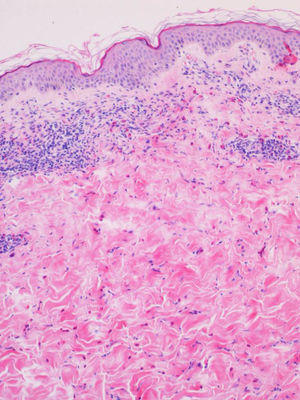 A predominantly perivascular inflammatory infiltrate formed mainly of eosinophils can be observed in the superficial and deep dermis. Hematoxylin and eosin, original magnification ×40.