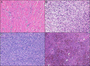 Histologic variants of dermatofibrosarcoma protuberans. A, Sclerotic. B, Myxoid. C, Fibrosarcomatous. D, Pigmented (Bednar tumor).