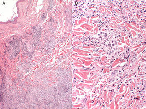 A, Superficial and deep dermal inflammatory infiltrate (hematoxylin-eosin, original magnification, ×4). B, Tendency to form interstitial granulomas in some areas, with a more nodular appearance in others (no fibrinoid necrosis), surrounded by mature lymphocytes without cytologic atypia (hematoxylin-eosin, original magnification, ×10).