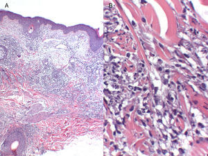 A, Superficial and deep perivascular and periadnexal inflammatory infiltrate (hematoxylin-eosin, original magnification, ×4). B, Inflammatory infiltrate composed of mature lymphocytes and interstitial histiocytic granulomas, without necrosis (hematoxylin-eosin, original magnification, ×20).