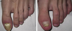 A, Erythema and edema in the proximal nail fold and proximal onychomadesis, with a thick, yellowish nail plate. B, Appearance of the new nail at 12 months, with distal yellowing and thickening.