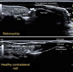 Ultrasound study: longitudinal image characteristic of retronychia, with 2 overlapping nail plates and a hypoechoic space between them, together with posterior acoustic shadowing under the lower nail plate. Lower panel, healthy contralateral nail. DIJ indicates distal interphalangeal joint; PNF, proximal nail fold.