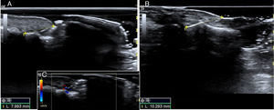 A and B, Ultrasound-based comparison between images from the great toes. In the nail affected by retronychia (A), the distance between the root of the nail plate and the base of the distal phalanx (at the level of the distal interphalangeal joint) is reduced. C, Enhanced Doppler signal in the proximal part of the nail bed.