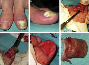 Surgical avulsion. A, Appearance of both nails before surgery. B, Affected nail higher proximally than distally. C, Proximal detachment with a Freer elevator. D, Removal of the nail plates using Radolf nail pulling forceps. E, Appearance of the nail bed after avulsion. F, Overlapping nail plates forming a “sandwich,” with granulation tissue between them at the proximal end.