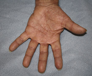 Vesicular lesions on an erythematous base on the palm of the first patient.