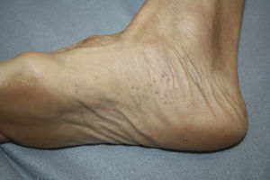 Vesicular blood-filled lesions on the sole of the first patient.