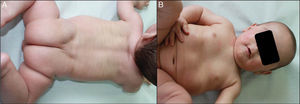 A and B, Normal skin at age 1 year, with only mild erythema and peeling on the cheeks.