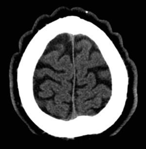 Cerebral computed tomography showing irregular skin folds (patient1).