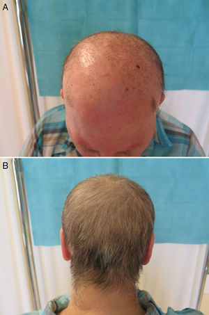 A, Frontal and parietal alopecia, with isolated hairs and follicular hyperkeratosis. B, Persistence of hair in the occipital region.