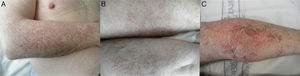 A, Symmetrical telangiectatic plaques on the lateral aspect of the forearms. B, Telangiectasias on the thighs. C, Telangiectasias on the lower legs.