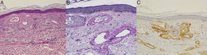 A, Dilated blood vessels with an irregular outline and thickened walls in the papillary dermis. Hematoxylin-eosin, original magnification ×40). B, Deposits of a homogeneous, eosinophilic, periodic acid-Schiff (PAS)-positive material around the vessel lumina. PAS-diastase, original magnification ×100).C, Immune staining of these same deposits was positive for type iv collagen.