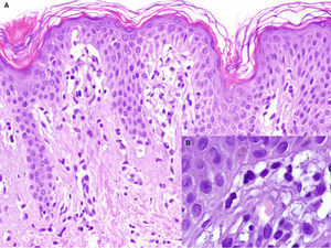 A. Hematoxylin-eosin, original magnification,×100. Biopsy of the edge of the lesion. Elongated rete ridges with a lichenoid lymphocytic infiltrate at the top of the dermal papillae and vacuolization of the basal layer. B. Hematoxylin-eosin, original magnification,×400. Greater detail showing multiple apoptotic keratinocytes.