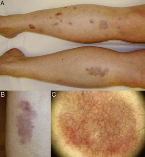 A, Well-defined, round and oval plaques affecting the anterior aspect of both lower legs. B, Detail of an isolated erythematous lesion, with orange, yellowish, brownish, and whitish areas; superficial atrophy and numerous telangiectasias can be observed. C, Dermoscopic image showing a dense network of branching anastomosing vessels on a yellow-orange background with whitish areas.