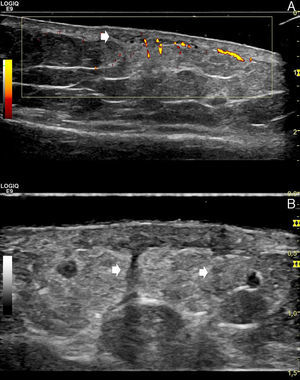 A, Power Doppler ultrasound (linear 15MHz transducer; longitudinal axis, left leg): hypoechoic areas in the mid and deep dermis (arrow), with blurring of the dermohypodermal junction and a diffusely increased echogenicity of the underlying superficial hypodermal adipose tissue. Power Doppler shows increased dermal and superficial hypodermal flow. The image allows us to compare the affected area (right side of the image) with healthy perilesional skin (left side of the image). B, Gray-scale ultrasound (linear 18MHz transducer; longitudinal axis, left leg). The hypoechoic vertical bands correspond to thickened septa (arrows).