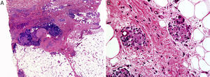 A, Predominant involvement of the mid and deep dermis, with areas of degenerated collagen surrounded by palisaded histiocytes and a lymphocytic and plasma-cell infiltrate. B, The inflammatory changes extend into the subcutaneous cellular tissue, with foci of degenerated collagen surrounded by histiocytes in the connective tissue septa, forming granulomas of vaguely sarcoid appearance.
