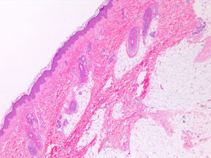 Skin biopsy showed an excessive accumulation of adipose tissue in the superficial dermis.