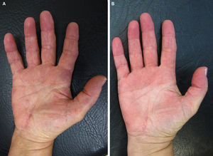 A, Indurated, papular erythematous-violaceous lesions on the palms and volar surface of the fingers. B, Complete resolution of the lesions after treatment.