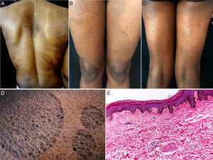 A, Hyperpigmented oval plaques on the back. B and C, Multiple oval lesions on the thighs. D, Close-up image showing ichthyosiform flaking with sharp, well-defined borders. E, Compact hyperkeratosis, thinning of the epidermis, absence of the granular layer, flattening of the epidermal crests, hyperpigmentation of the basal keratinocytes, a mild perivascular infiltrate, and few skin adnexa. Hematoxylin and eosin, original magnification×10.
