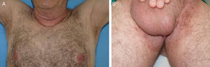 A and B, Complete resolution of the lesions in the axillary and inguinal skin folds 16 months after initiating treatment with doxycycline.