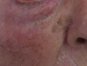 Flat pigmented lesion on the face of an elderly person.