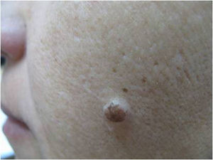 Melanocytic nevus on the face of an adult.