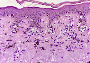 In situ melanoma: biopsy of facial skin. Nests of melanocytes along the dermoepidermal junction and dense deposits of solar elastosis. Hematoxylin eosin ×200.