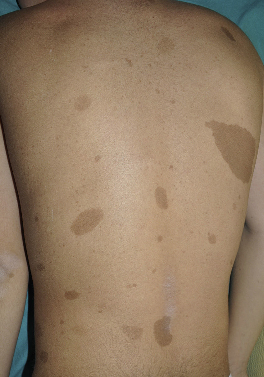neurofibromotosis glutathione Clinical Challenges: Hope and Caution in the Neurofibromatosis Drug Pipeline Neurofibromatosis Type 1 (NF1) -