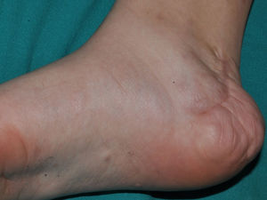 Diffuse subcutaneous neurofibroma on the inner side of the foot of an adolescent girl with NF1. The scar from partial excision of the tumor can be seen.