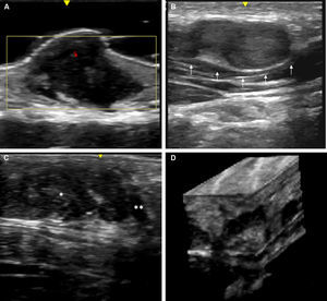 High-resolution ultrasound image (20MHz) of different neurofibromas. A. Cutaneous superficial neurofibroma where a well-delimited hypoechoic area can be seen in the dermis with a minimal Doppler signal (red color). B. Nodular subcutaneous neurofibroma of the patient in Fig. 9, in which a bilobulated, well-delimited, heteroechogenic lesion can be seen with mild posterior reinforcement that follows the path of a laterocervical peripheral nerve. C. Subcutaneous neurofibroma that occupies the subcutaneous cell tissue and deep dermis in which diffuse areas (*) and chordal areas (**) can be observed. D. Three-dimensional ultrasound reconstruction in which a convoluted linear area can be seen associated with thickening of a peripheral nerve.