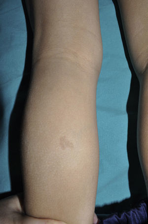 Hyperchromic nevus on the posterior face of the leg of a healthy patient. Note the irregular edge of the lesion, completely different to the smooth border of typical CaLS.