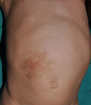 Diffuse congenital subcutaneous superficial neurofibroma (congenital superficial plexiform neurofibroma) in a 9-month-old patient. An extensive hyperpigmented lesion is observed on the right side of the abdomen.