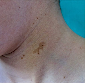 Café-au-lait spots with polygonal shapes in 2 patients with LEOPARD syndrome. Source: Taken from Ramos-Geldres et al.27