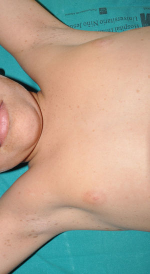 Multiple axillary freckles in an 9-year-old patient. In addition to the typical axillary involvement, numerous freckles can be seen on the neck and chin.