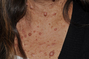 Typical cutaneous neurofibromas in an adult woman. Multiple pedunculated lesions above the neckline.