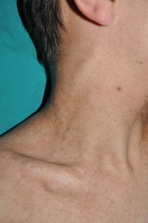 Subcutaneous nodular neurofibroma on the right side of the neck in a young adult with NF1.