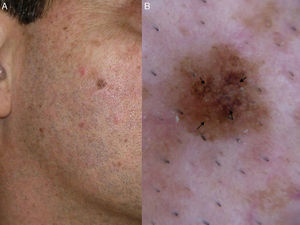 Lentigo maligna. A, Flat brown symmetric lesion with a diameter of 6mm on the right cheek of an adult. B, Dermoscopic features: asymmetric pigmented follicular openings (black arrows).