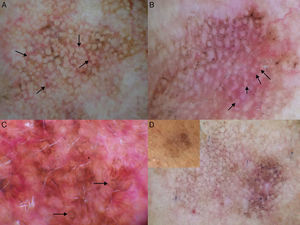 Additional dermoscopic features of lentigo maligna. A, Increased vascular density (black arrows) together with asymmetric pigmented follicular openings and gray dots. B, Red rhomboidal structures (black arrows) and a gray granular-annular pattern. C, Target-like pattern (white arrows) and rhomboidal structures. D, Detection of darker colors in the dermoscopic examination compared with naked-eye inspection (box).