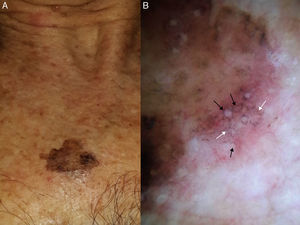 Extrafacial lentigo maligna. A, Irregular dark brown and black lesion, measuring 2cm at its longest point, in the neckline area. B, Dermoscopic features: asymmetric pigmented follicular openings (black arrows), gray dots forming granular-annular pattern (white arrows), and brown structureless areas.