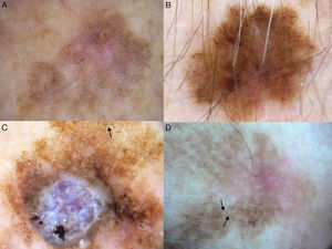 A-D, Dermoscopic features of extrafacial lentigo maligna; lesions located on the upper limbs. Note the gray dots forming a granular-annular pattern in some sectors, the brown structureless areas, and the rhomboidal structures (black arrows). Lesion C is lentigo maligna melanoma; note the whitish-blue veil.
